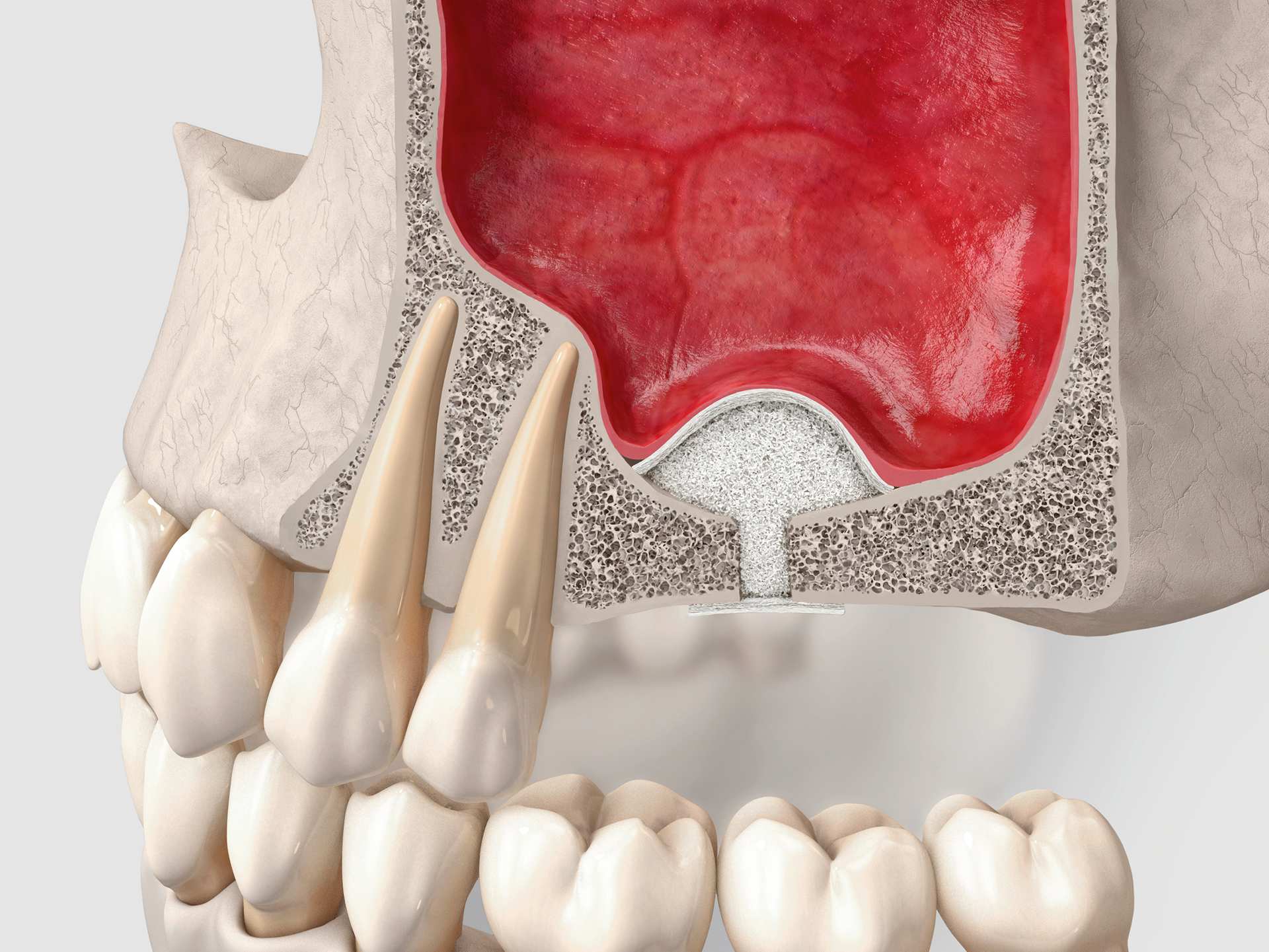 Sinus Floor Elevation - Lateral and Transcrestal Approach